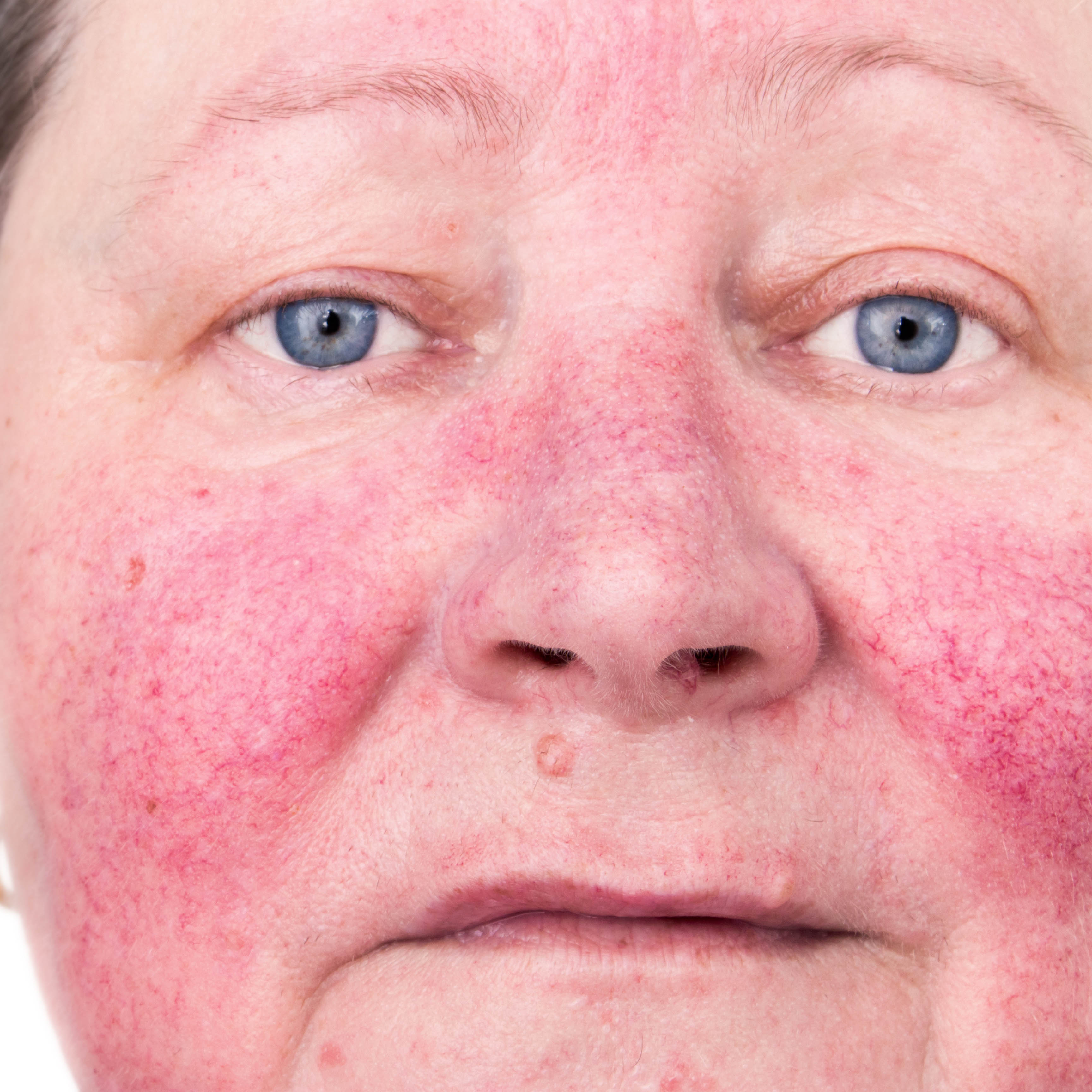 Rosacea Dermatology And Mohs Surgery
