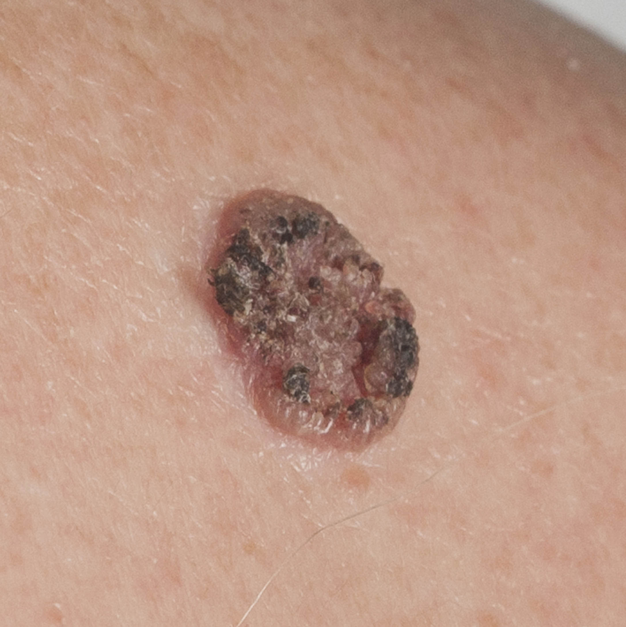 Squamous Cell Skin Cancer