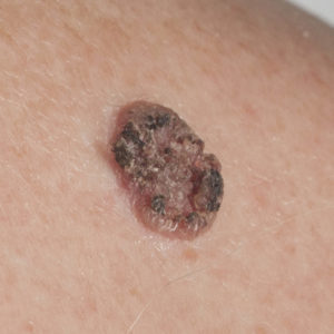 Squamous Cell Carcinoma – Dermatology & Mohs Surgery